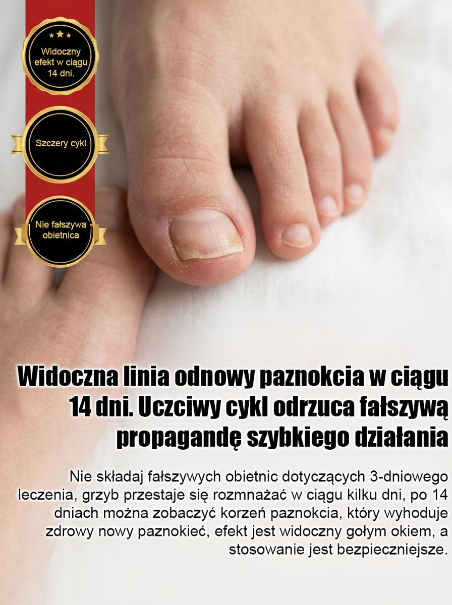 【Bezbolesna wymiana paznokci】Ziołowy łagodny płyn do naprawy paznokci dotkniętych grzybicą