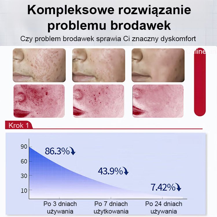 【Jednosekundowy usuwacz brodawek】Krem do usuwania brodawek